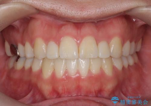 オフィスホワイトニングで、歯を白く!!の治療前