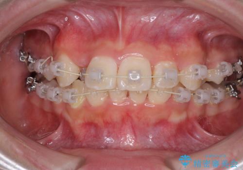 インビザラインが続けられない　ワイヤー矯正での抜歯矯正　その2の治療中