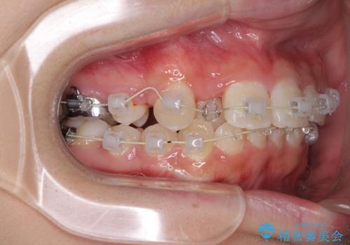 インビザラインが続けられない ワイヤー矯正での抜歯矯正 その2の治療中