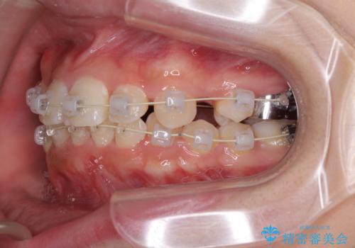 インビザラインが続けられない ワイヤー矯正での抜歯矯正 その2の治療中