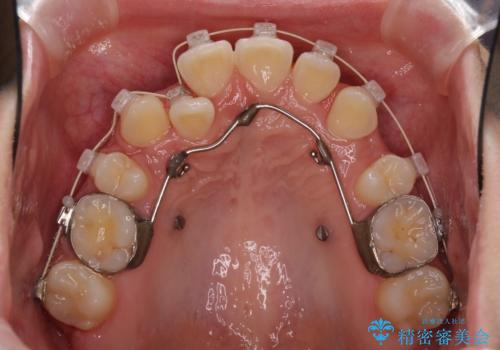 インビザラインが続けられない ワイヤー矯正での抜歯矯正 その2の治療中