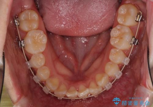 インビザラインが続けられない　ワイヤー矯正での抜歯矯正　その2の治療中