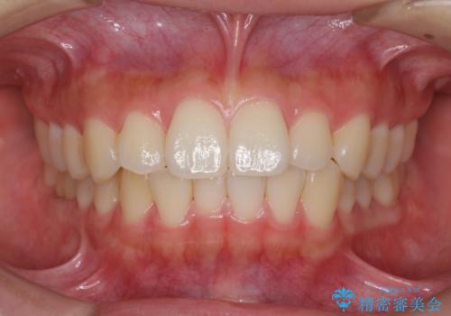 インビザライン モニターで前歯をきれいに