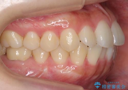 インビザライン モニターで前歯をきれいにの治療前