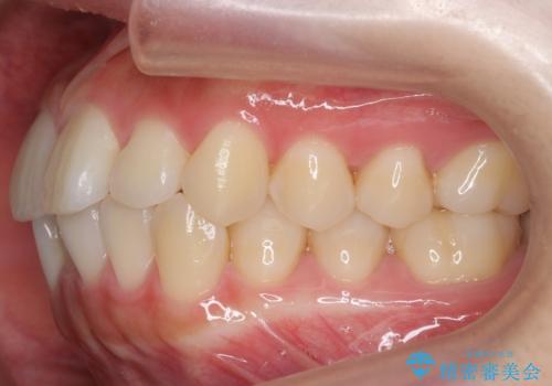 インビザライン モニターで前歯をきれいにの治療前