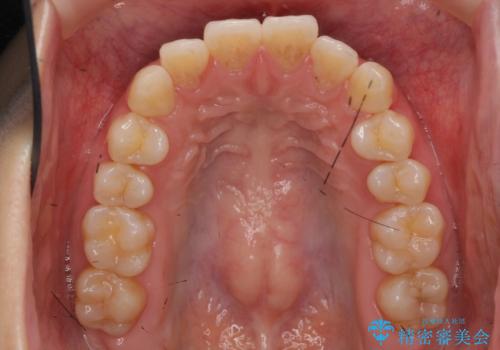 インビザライン モニターで前歯をきれいにの治療前