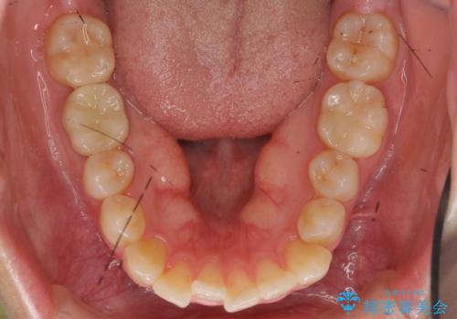 インビザライン モニターで前歯をきれいにの治療前