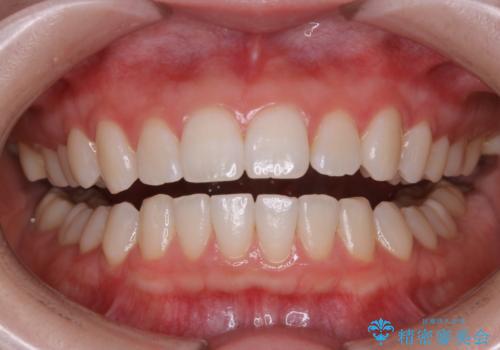 オフィスホワイトニング(エクセレントコース)  高濃度の薬剤使用!の治療後