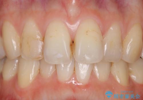 前歯2本の着色が気になる、、、セラミック治療の症例 治療前