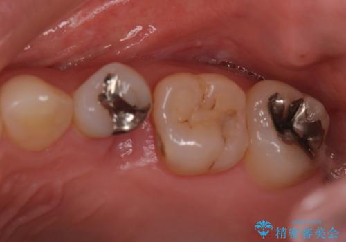銀歯と歯の形が気になる　セラミックの症例 治療前