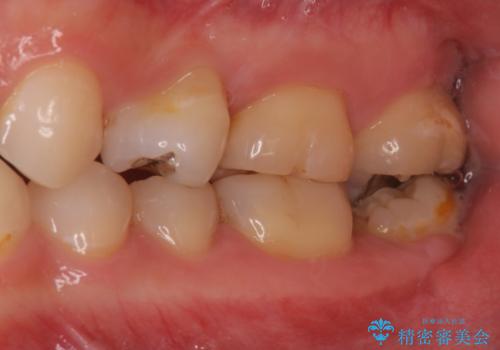 銀歯と歯の形が気になる　セラミックの治療前