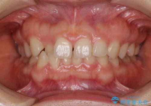 【モニター】前歯の歯列不正をワイヤー装置で短期間矯正治療の症例 治療前