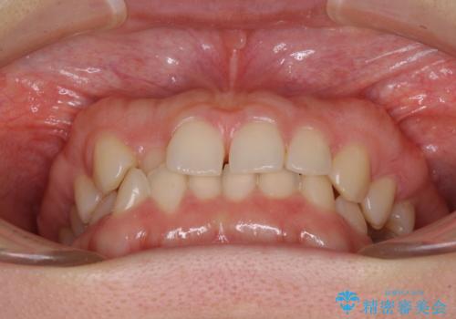 【モニター】前歯の歯列不正をワイヤー装置で短期間矯正治療の治療前