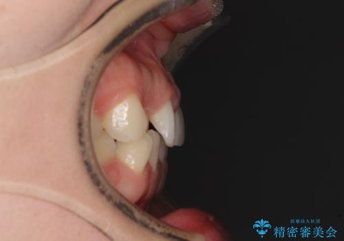 【モニター】前歯の歯列不正をワイヤー装置で短期間矯正治療の治療前