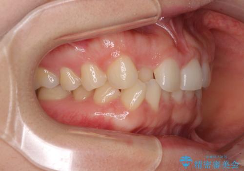 【モニター】前歯の歯列不正をワイヤー装置で短期間矯正治療の治療前
