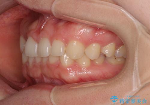 【モニター】前歯の歯列不正をワイヤー装置で短期間矯正治療の治療前