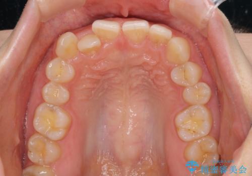 【モニター】前歯の歯列不正をワイヤー装置で短期間矯正治療の治療前