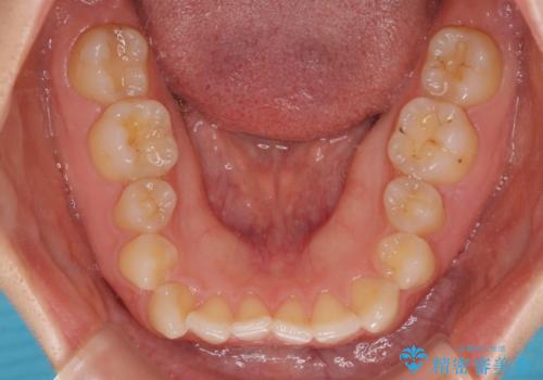 【モニター】前歯の歯列不正をワイヤー装置で短期間矯正治療の治療前