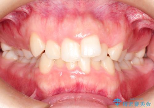 押しつぶされた歯列、アーチの拡大だけで非抜歯で改善した症例の症例 治療前