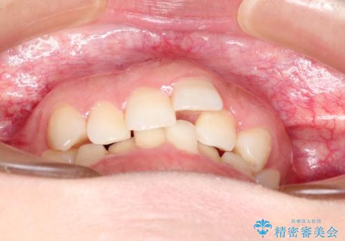 押しつぶされた歯列、アーチの拡大だけで非抜歯で改善した症例の治療前