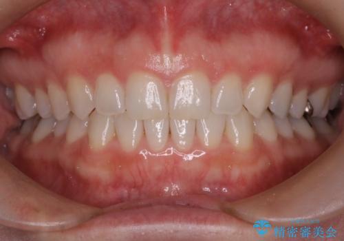長い間コンプレックスだった前歯のすき間! 短期間終了。部分矯正症例 (インビザライン矯正) の症例 治療後