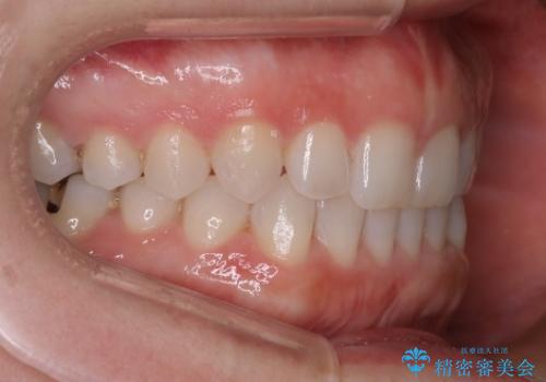 長い間コンプレックスだった前歯のすき間!　短期間終了。部分矯正症例　(インビザライン矯正)　の治療後