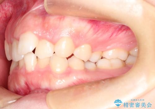 押しつぶされた歯列、アーチの拡大だけで非抜歯で改善した症例の治療前