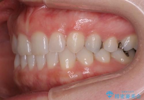 長い間コンプレックスだった前歯のすき間! 短期間終了。部分矯正症例 (インビザライン矯正) の治療後