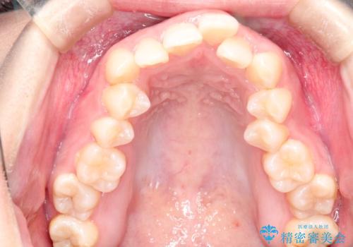 押しつぶされた歯列、アーチの拡大だけで非抜歯で改善した症例の治療前