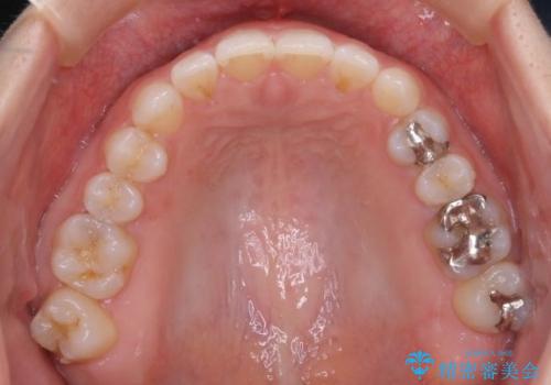 長い間コンプレックスだった前歯のすき間! 短期間終了。部分矯正症例 (インビザライン矯正) の治療後