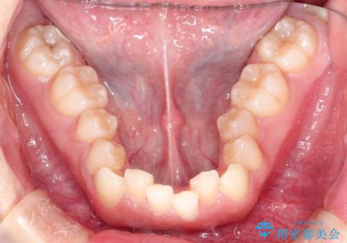 押しつぶされた歯列、アーチの拡大だけで非抜歯で改善した症例の治療前