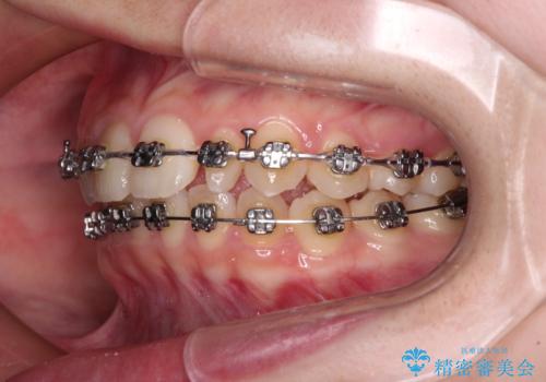 【モニター】ワイヤー矯正で手っ取り早く治療の治療中