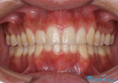 インビザラインによる出っ歯の矯正の治療後