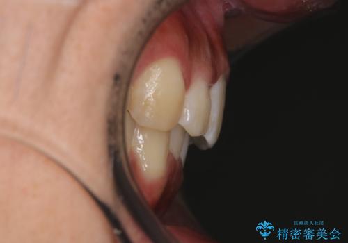 インビザラインによる出っ歯の矯正の症例 治療後