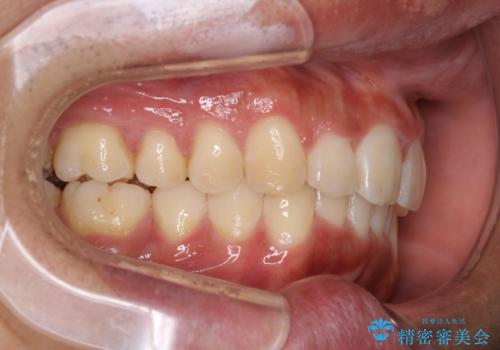 インビザラインによる出っ歯の矯正の治療後