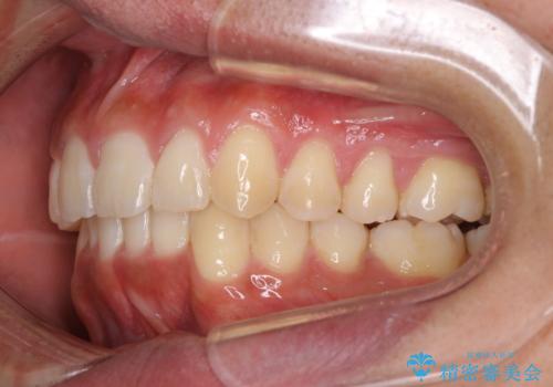 インビザラインによる出っ歯の矯正の治療後
