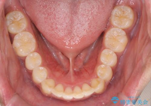 インビザラインによる出っ歯の矯正の治療後