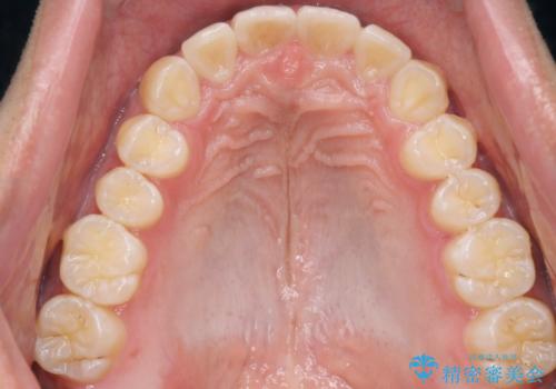 インビザラインによる出っ歯の矯正の治療後