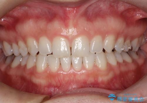 長い間コンプレックスだった前歯のすき間!　短期間終了。部分矯正症例　(インビザライン矯正)　の治療中