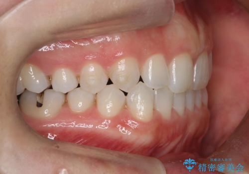 長い間コンプレックスだった前歯のすき間! 短期間終了。部分矯正症例 (インビザライン矯正) の治療中