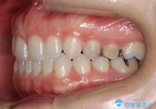長い間コンプレックスだった前歯のすき間! 短期間終了。部分矯正症例 (インビザライン矯正) の治療中