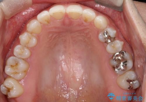 長い間コンプレックスだった前歯のすき間! 短期間終了。部分矯正症例 (インビザライン矯正) の治療中