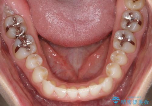 長い間コンプレックスだった前歯のすき間!　短期間終了。部分矯正症例　(インビザライン矯正)　の治療中