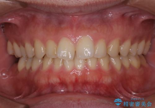 歯石取りをしてほしいの治療前