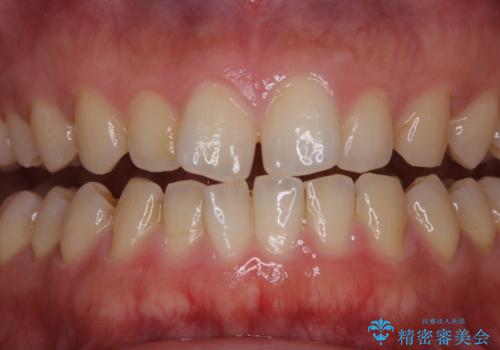 歯石取りをしてほしいの治療前