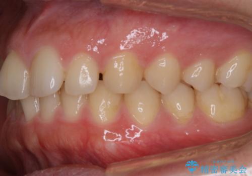 歯石取りをしてほしいの治療前