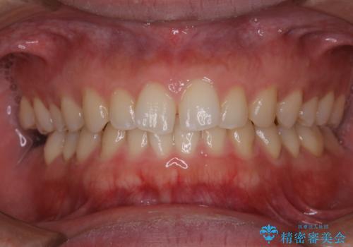 歯石取りをしてほしいの治療後