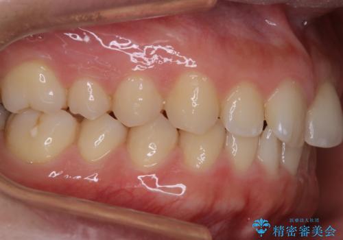 歯石取りをしてほしいの症例 治療後
