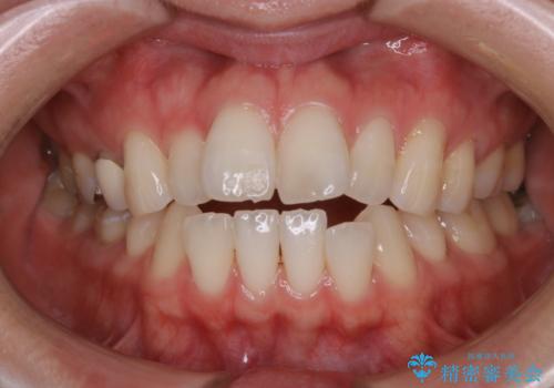 初めてのホワイトニングで自然に白くの治療前