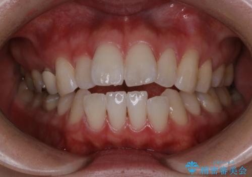 初めてのホワイトニングで自然に白く